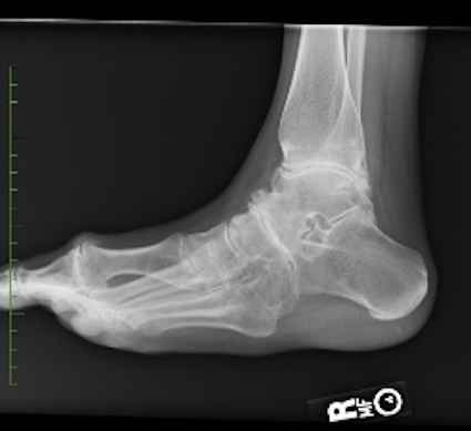 Figure 2 for case Kneist dysplasia